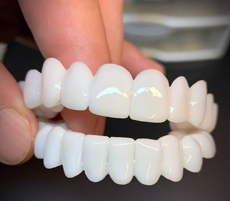Hudson & Jurgen – Opklikbare tandfineers met aangepaste pasvorm voor een natuurlijke glimlach