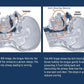 Apnea Tongue Stabilizing Device